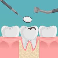 Teeth with decay in gum. Tooth with caries hole treatment concept. Dentist's tools. Flat dentistry vector illustration.