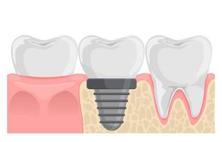 Dental implant Tooth replacement. Teeth in gum anatomy. Flat vector illustration isolated on white.