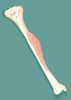 Representation of bone cancer - vector illustration