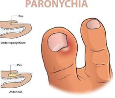 inforaphic illustration of paronychia in a toe vector