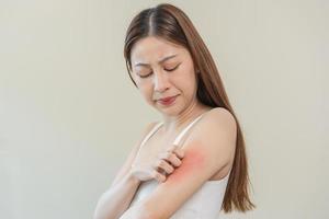 Dermatology asian young woman, girl allergy, allergic reaction from atopic, insect bites on her arm, hand in scratching itchy, itch red spot or rash of skin. Healthcare, treatment of beauty. photo