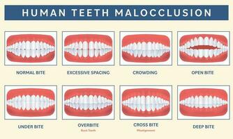 maloclusión de el humano dientes infografía icono conjunto terminado melocotón antecedentes. vector