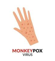 mano con viruela del simio plano diseño vector ilustración. enfermedad untado alerta. brote virus infecciones