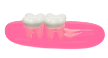 Dental Untersuchung von das Zahnarzt, 3d Weisheit Zähne Modell- Probleme Symbol mit Zahnfleisch isoliert. Gesundheit von Weiß Zähne, Oral Pflege, 3d machen Illustration png