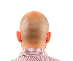 Baldness isolated on white photo