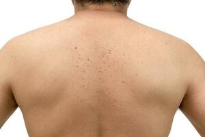 skin tags or Seborrheic Keratosis on back photo