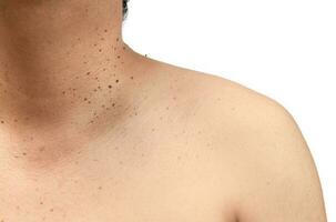 Closed up the skin tags or Seborrheic Keratosis on neck photo