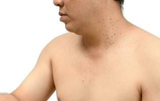 skin tags or Seborrheic Keratosis on neck photo