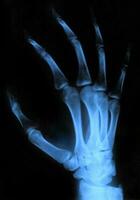 X-ray hand, medical image. photo