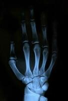 X-ray hand, medical photography. photo