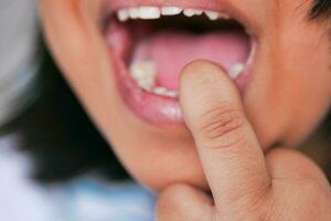 detail shot of child with teeth missing photo