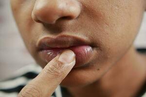 joven aplicando bálsamo labial hidratante en los labios foto