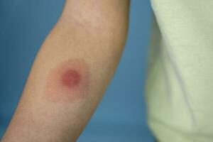 mantoux vaccination, Closeup view photography of kid's arm with red spot reaction to conducting Mantoux test photo