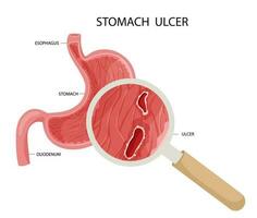 Peptic ulcer in stomach under magnyfication vector