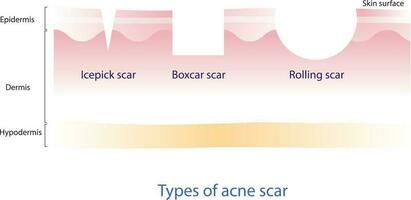 Types of acne scar vector on white background. Cross section of icepick scar, boxcar scar and rolling scar with skin layer. Skin care and beauty concept illustration.