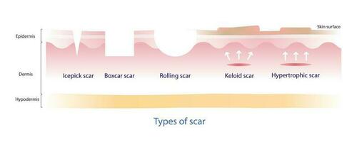 Types of  scar vector, icepick scar, boxcar scar, rolling scar, keloid scar and hypertrophic scar on white background. Skin care and beauty concept illustration. vector