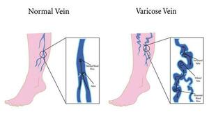 set of Varicose veins poster. Vector flat style cartoon varicose illustration isolated on white background