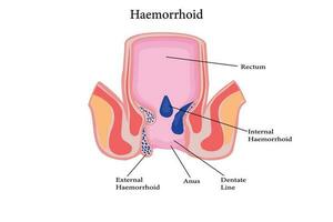 Cross section of the rectum and anal canal. illustration of hemorrhoids structure vector