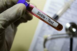 Sickle - Test with blood sample. Top view isolated on office desk. Healthcare Medical concept photo