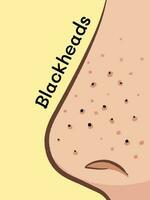 Blackheads on close up nose vector illustration isolated on yellow vertical background. Side view cartoon drawing with simple flat art style.