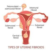 Types of uterine fibroids in women. Fibroids. Diseases of the female reproductive system. Gynecology. Medical concept. Infographic banner. Vector