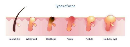 Types of acne vector isolated on white background. Formation of normal skin, acne, pimple, comdone, non inflammation acne, whitehead, blackhead, inflammation acne, papule, pustule, nodule and cyst.