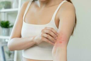 dermatología asiático joven mujer, niña alergia, alérgico reacción desde atópico, insecto picaduras en su brazo, mano en rascarse que produce picor, picar rojo Mancha o erupción de piel. cuidado de la salud, tratamiento de belleza. foto