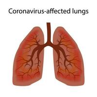 Human lungs damaged by coronavirus covid-19. The concept of the stage of damage to the respiratory tract virus. Isolated vector EPS10.