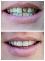 Smiling woman with a bad tooth before and after treatment. Close-up. Veneers, whitening, building. Collage photo