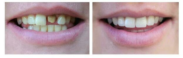 Smiling woman with a bad tooth before and after treatment. Close-up. Veneers, teeth cleaning, building. Collage photo