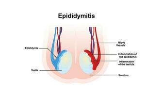 Epididymitis is inflammation of the epididymis of the testicle. vector