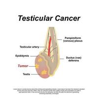 un masculino anatomía de testicular cáncer vector