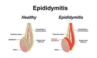 epididimitis es inflamación de el epidídimo de el testículo. vector