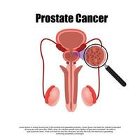 Prostatitis normal and inflamed prostate isolated vector