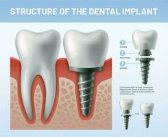 Dental teeth implant. Implantation procedure or tooth crown abutments. Health care vector illustration