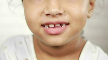 enfant fille avec des dents déformées video