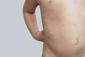 Boy with multiple and insect bites on body photo