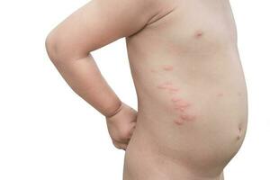 Boy with multiple and insect bites on body on white background photo
