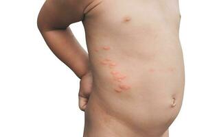 Boy with multiple and insect bites on body on white background photo