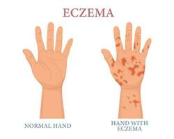 Eczema, healthy and unhealthy hand. Dermatology. The concept of medicine and healthcare. Poster, banner, vector