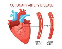 enfermedad de el coronario artería de el corazón. humano anatomía, médico concepto. infografía, bandera, vector