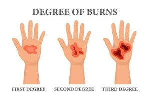 Burn stages. Burnt hands at various degrees. Skin burn symptoms. Medical healthcare concept. Vector