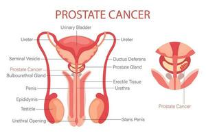 Prostate cancer. Male reproductive system. Anatomy of the internal organs of man. Infographic banner, diagram, vector