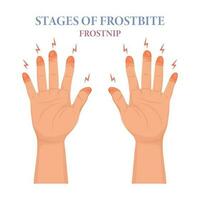 Frozen hands in different stages. Medical frostbite. Stages of frostbite of fingers. Skin burn symptom. Medical healthcare concept. Vector