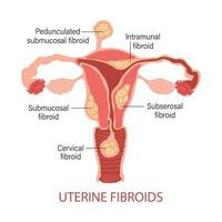 Types of uterine fibroids in women. Fibroids. Diseases of the female reproductive system. Healthy and unhealthy uterus. Gynecology. Medical concept. Infographic banner. Vector