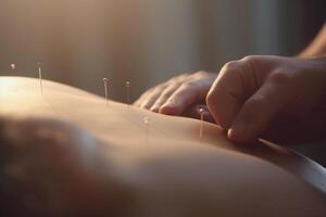 Close-up of Acupuncture Needles Inserted into Skin with Hands Placed on Top photo