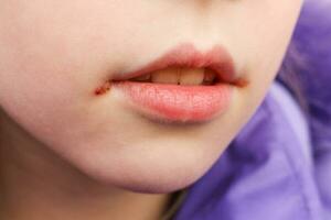 Herpes on lips of child. Treatment ointment. photo