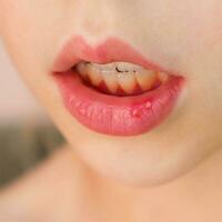Stomatitis on the lip in child photo