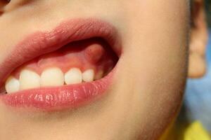 Swelling on gums the child. photo