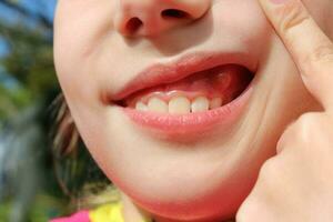 Close up  swelling on gums the child. photo